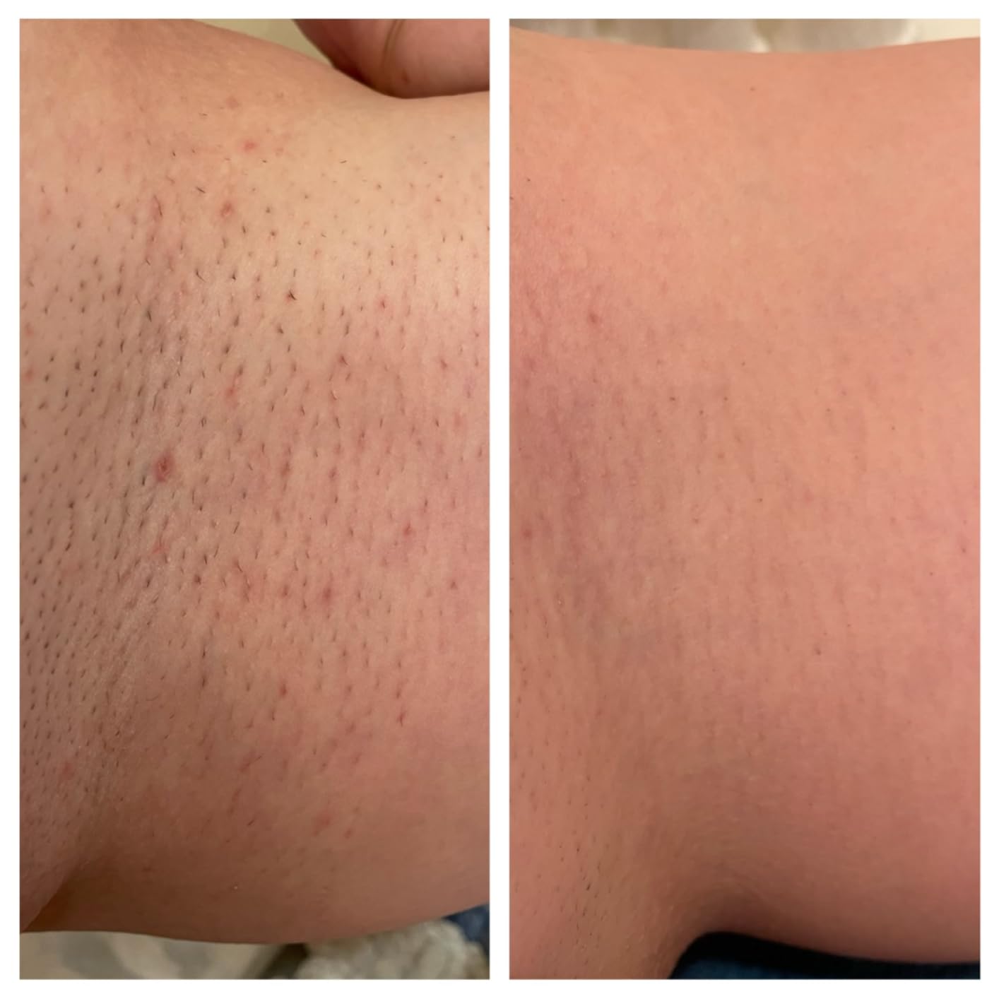 Braun IPL, Silk·Expert Pro 5, IPL Hair Removal for Women and Men, Permanent Laser Hair Reduction At-Home, 2 Heads, Pouch, IPL5137 customer photo 2