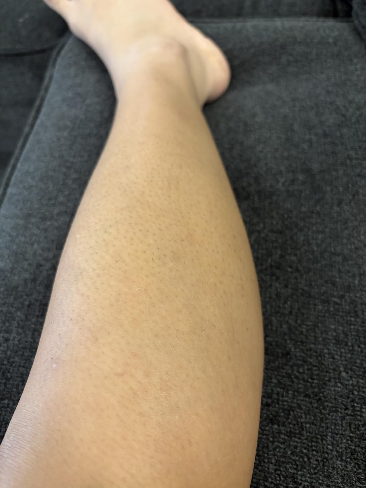 Ubroo Laser Hair Removal Hair Reduction in 2 Session(Gold) customer photo 1